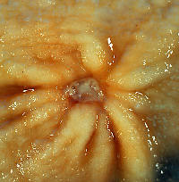 Gastic ulcer