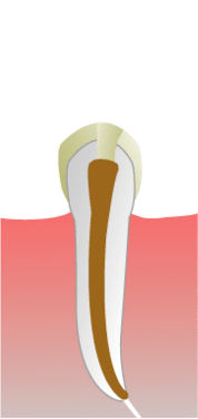 Root Canal procedure: unhealthy tooth, drilling, filing, rubber filling.