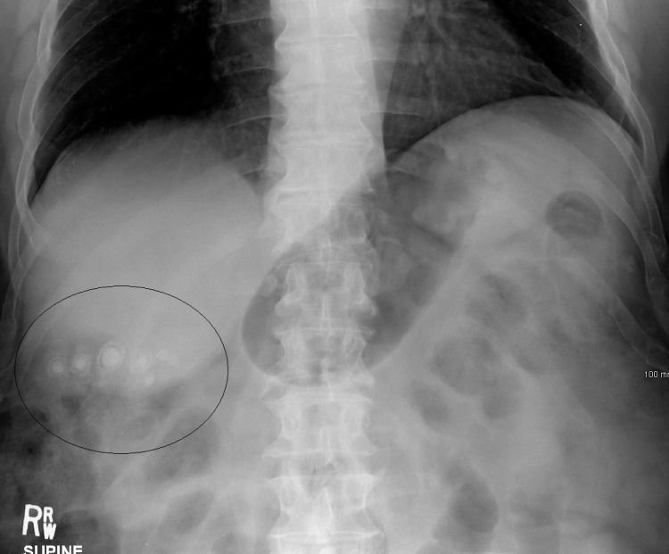 Gall stones as seen on plain X-ray