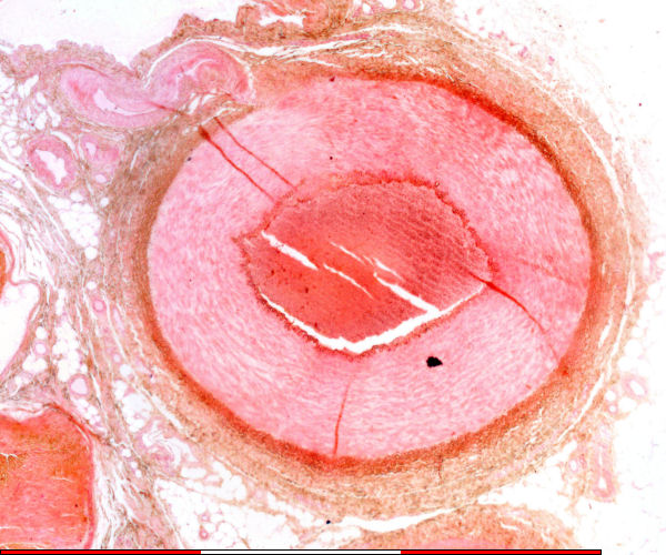 Muscular artery