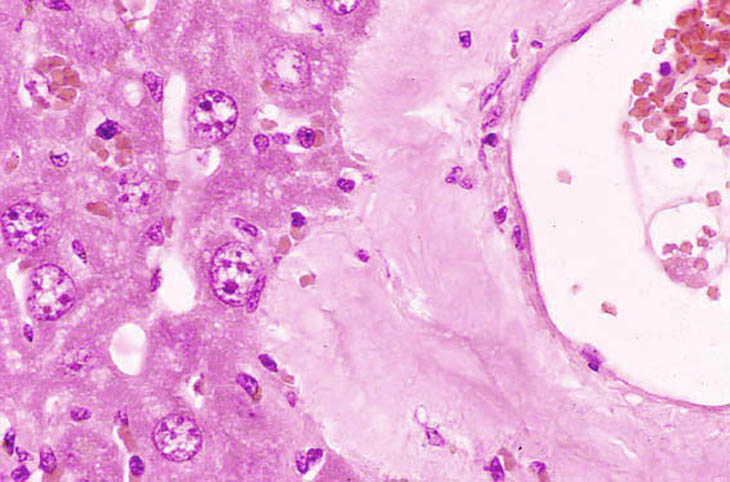 Amyloid deposition