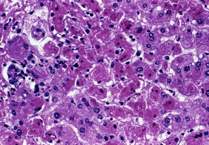 hepatocellular necrosis