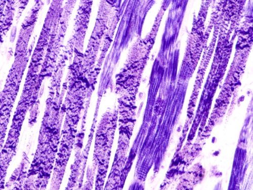 acute myocardial infarction