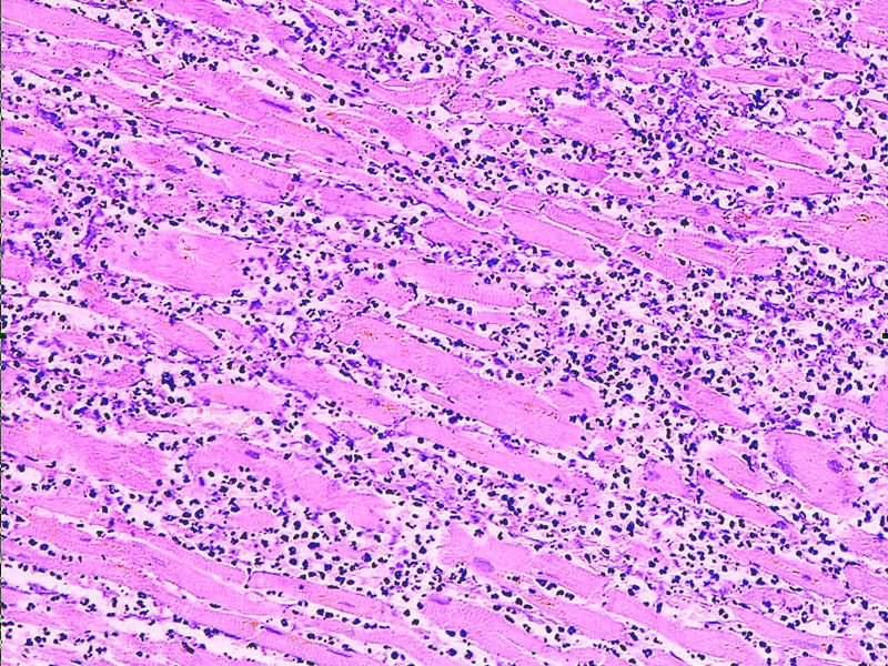 myocardial infarct