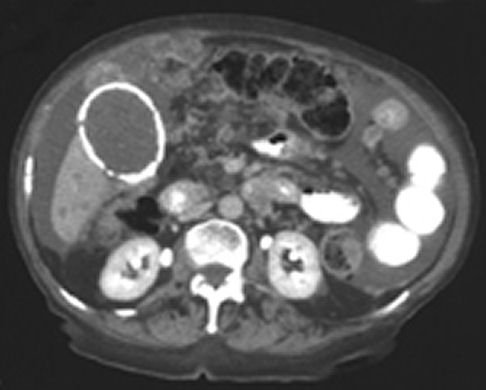 gall bladder