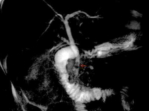 MRCP image of two stones in the distal common bile duct