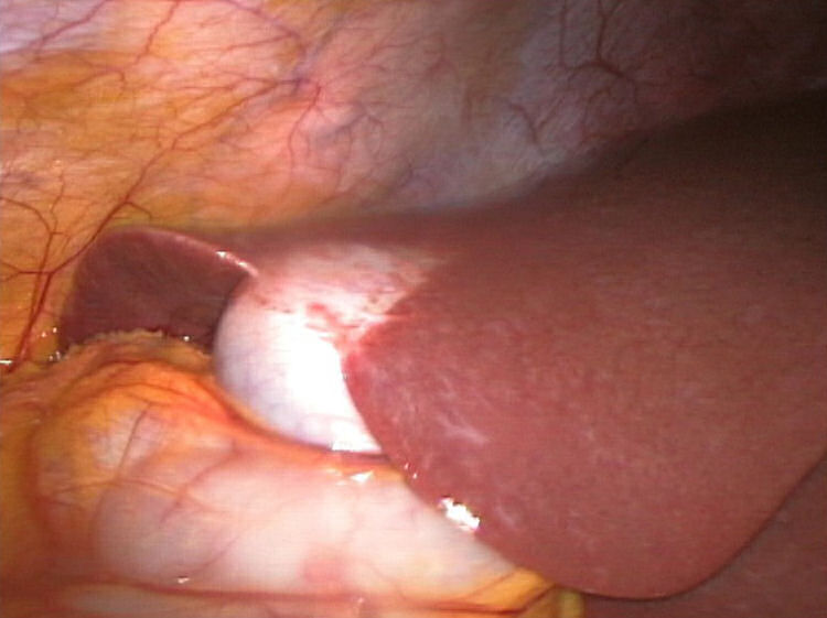 gall bladder