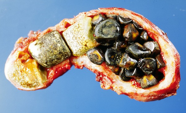 gall bladder with stones