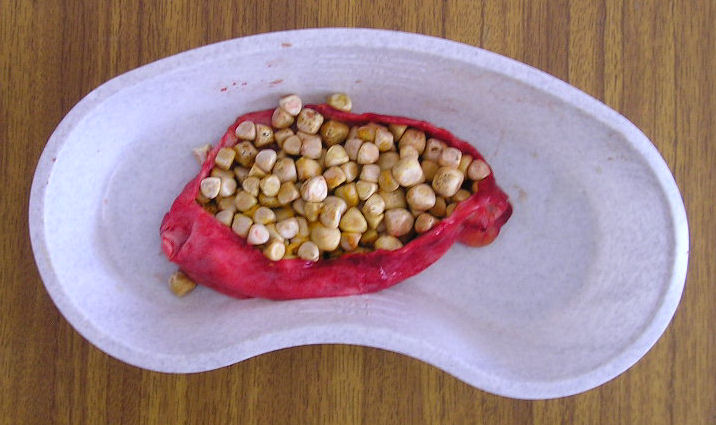 gall bladder with stones