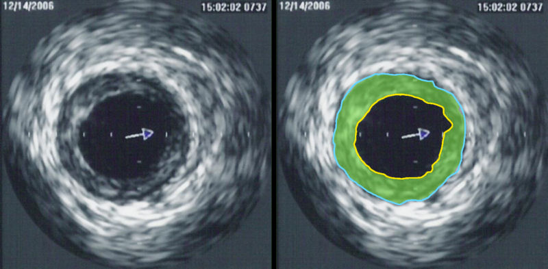 Intravascular ultrasound image of a coronary artery