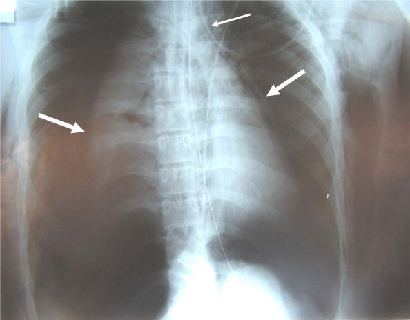 tracheobronchial injury