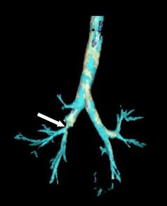 bronchial stenosis