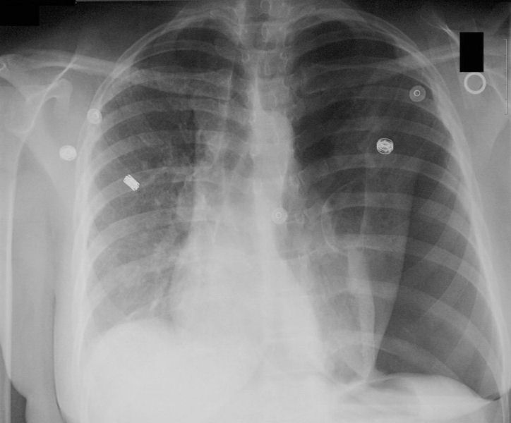 pneumothorax