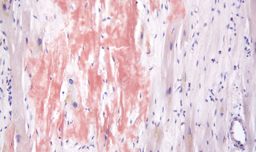 cardiac amyloidosis