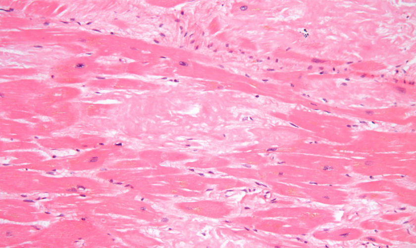 cardiac amyloidosis