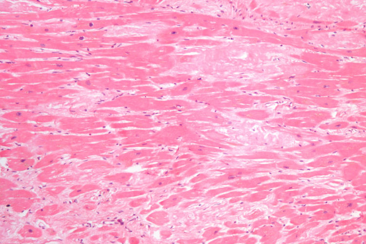 cardiac amyloidosis