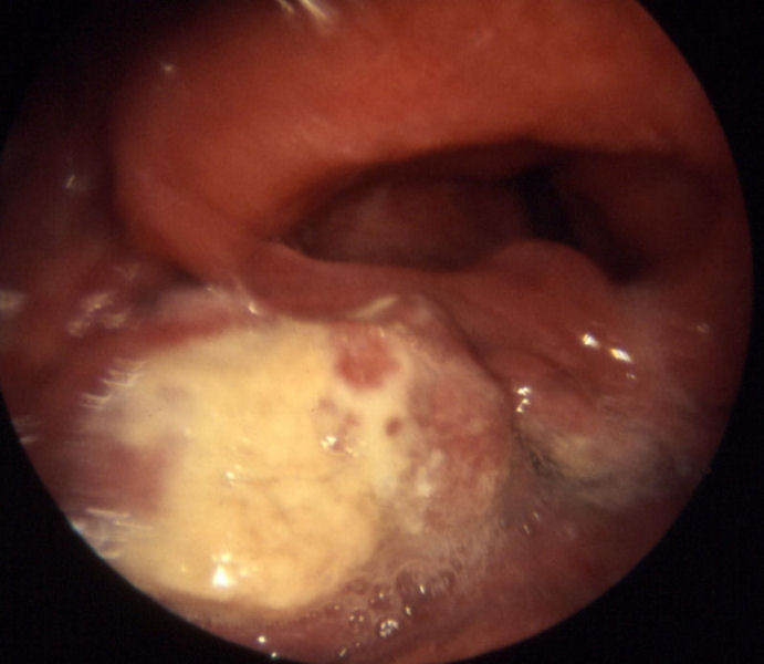 Hypopharynx carcinoma